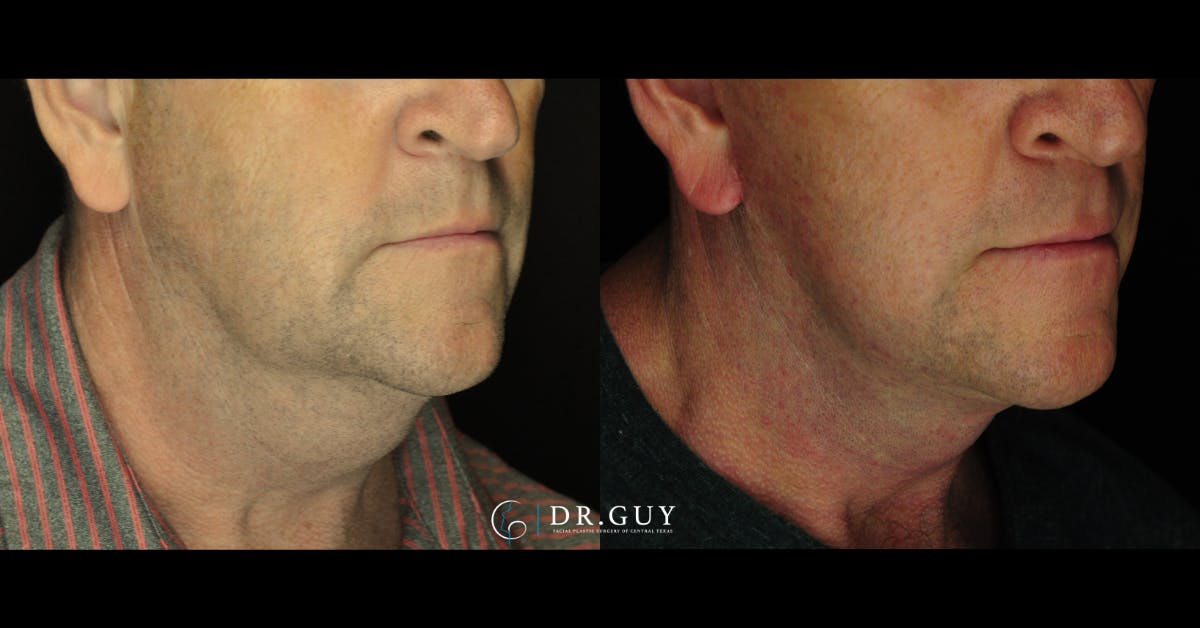 Facelift Before & After Gallery - Patient 303016 - Image 1