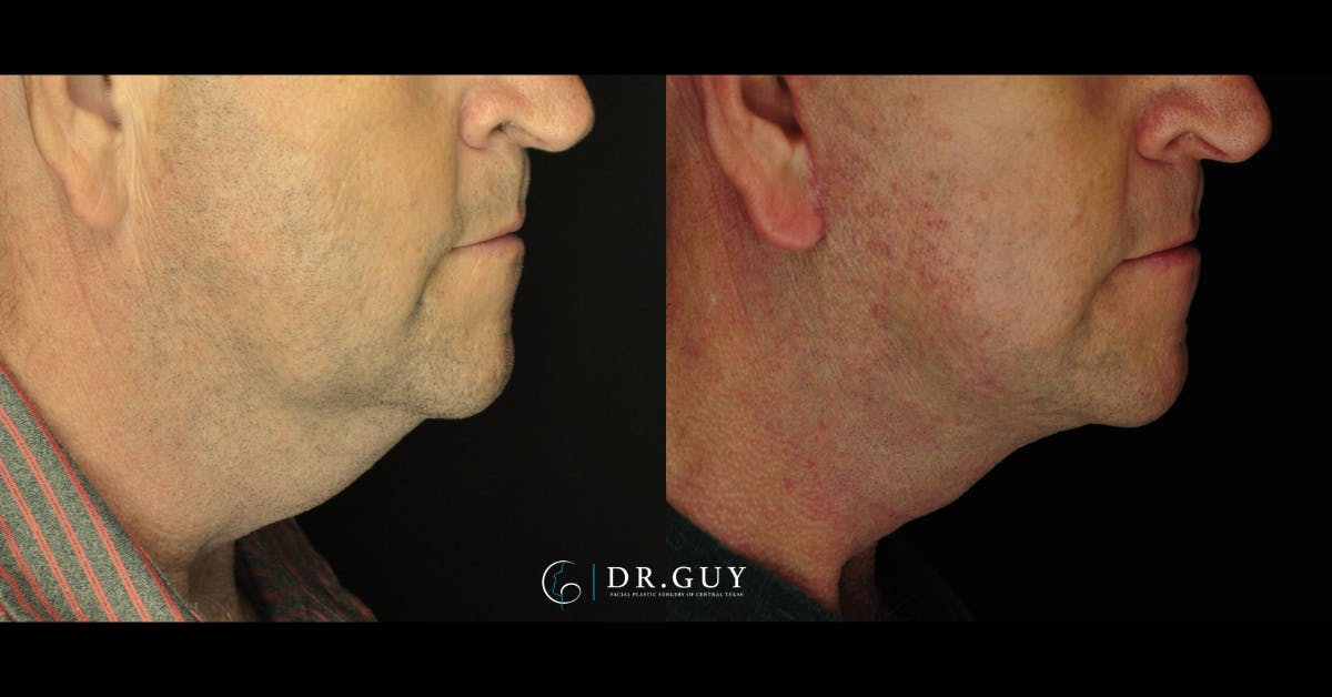 Facelift Before & After Gallery - Patient 303016 - Image 2