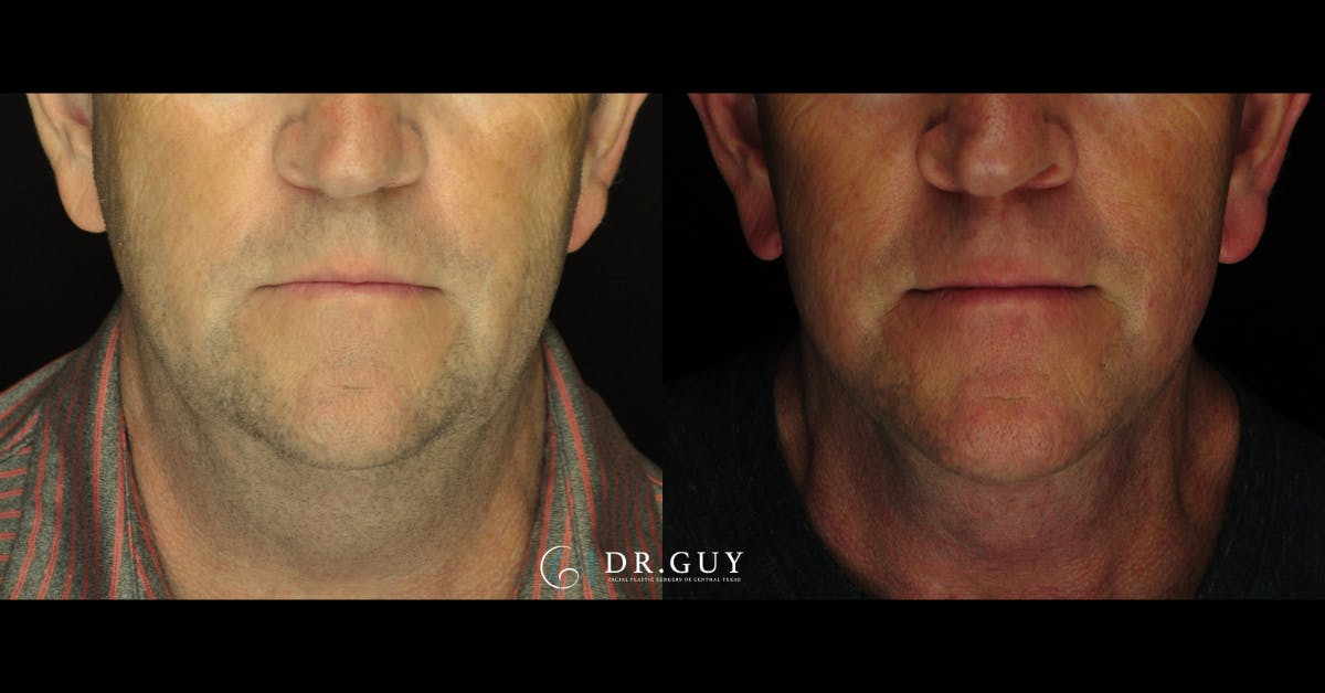 Facelift Before & After Gallery - Patient 303016 - Image 3
