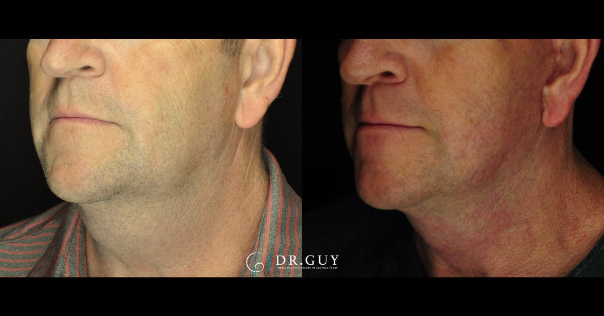 Facelift Before & After Gallery - Patient 303016 - Image 4