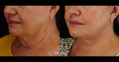 Facelift Before & After Gallery - Patient 157399 - Image 1