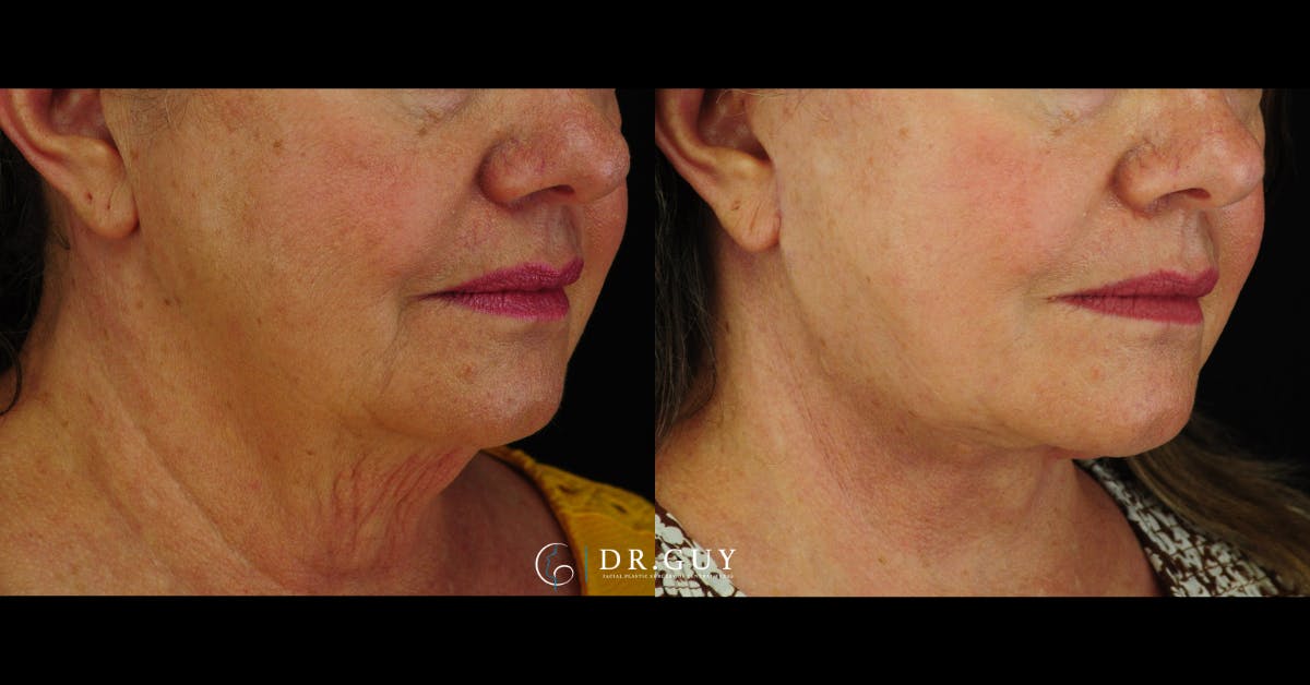 Facelift Before & After Gallery - Patient 157399 - Image 2