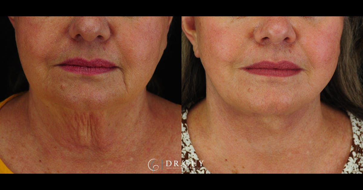 Facelift Before & After Gallery - Patient 157399 - Image 3