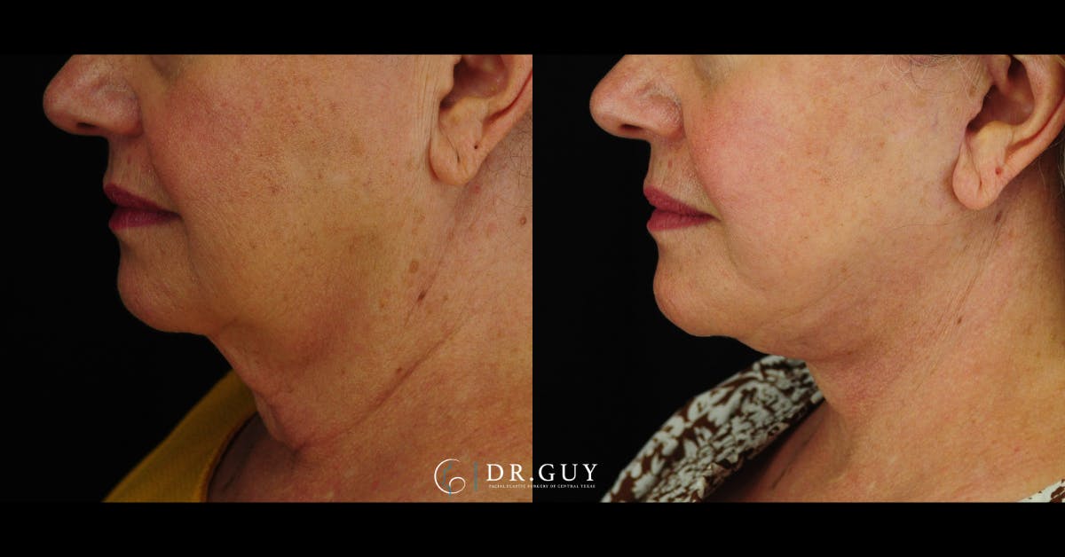 Facelift Before & After Gallery - Patient 157399 - Image 4