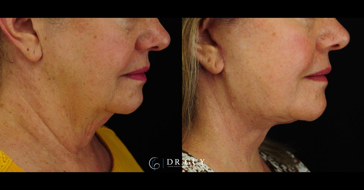 Facelift Before & After Gallery - Patient 157399 - Image 5