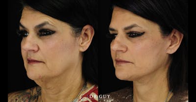 Facelift Before & After Gallery - Patient 287609 - Image 1