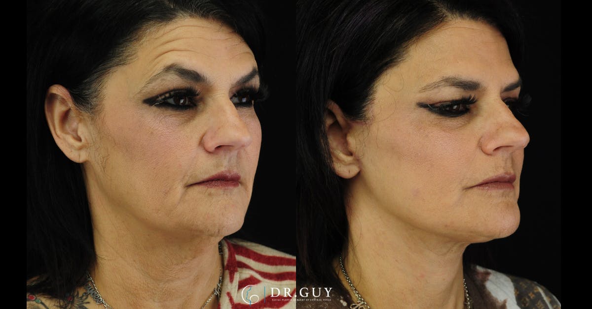 Facelift Before & After Gallery - Patient 287609 - Image 2