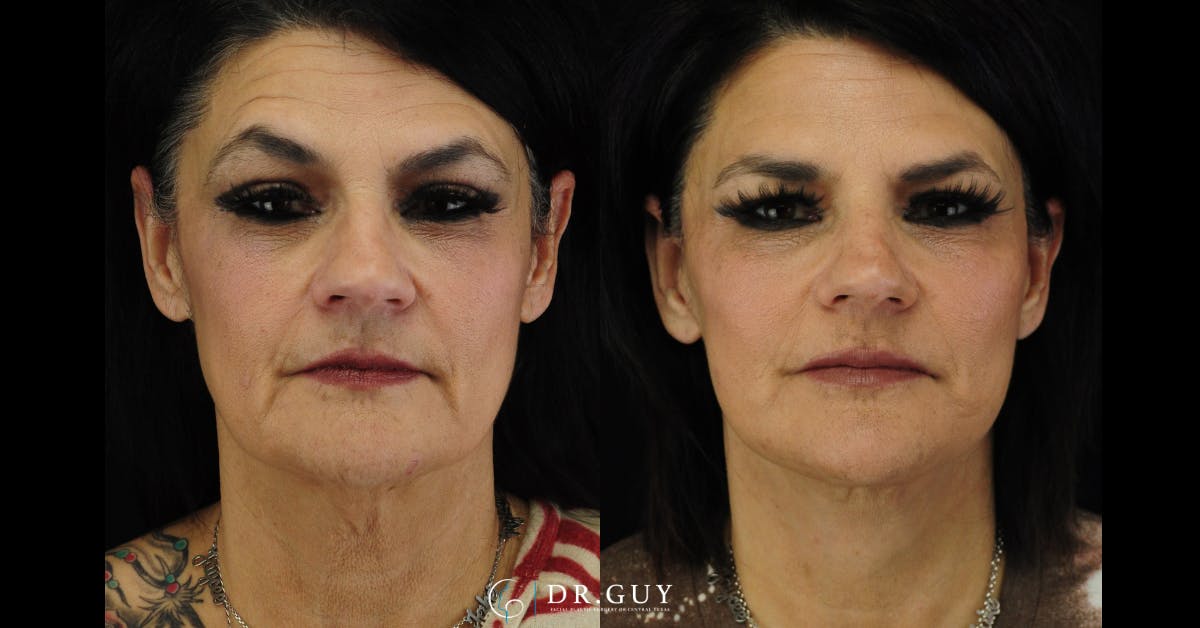 Facelift Before & After Gallery - Patient 287609 - Image 3
