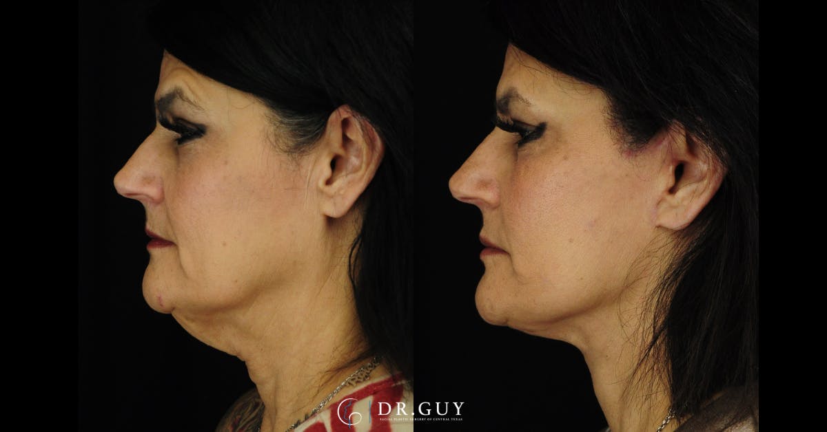Facelift Before & After Gallery - Patient 287609 - Image 4