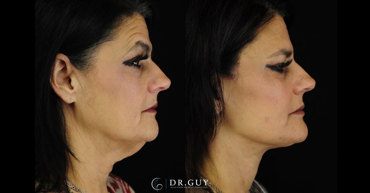 Facelift Before & After Gallery - Patient 287609 - Image 5
