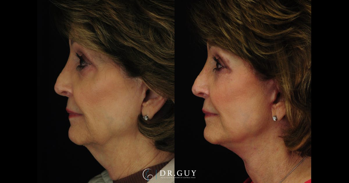 Facelift Before & After Gallery - Patient 707843 - Image 1