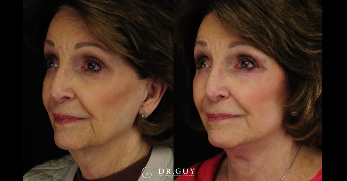 Facelift Before & After Gallery - Patient 707843 - Image 2