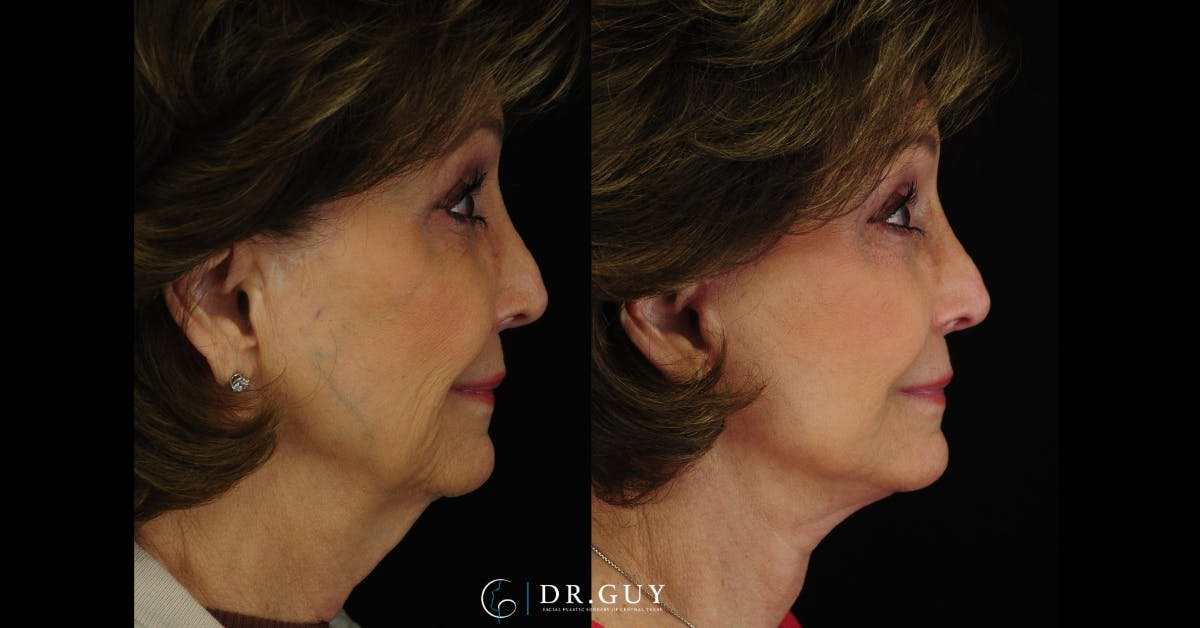 Facelift Before & After Gallery - Patient 707843 - Image 3