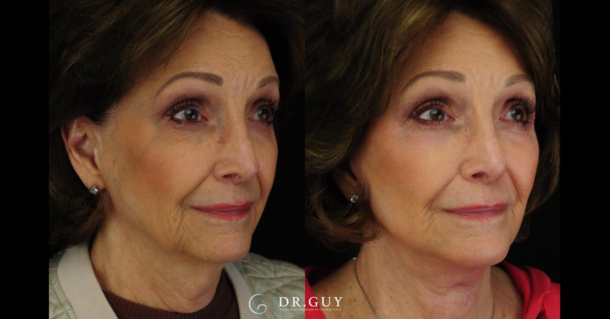 Facelift Before & After Gallery - Patient 707843 - Image 4