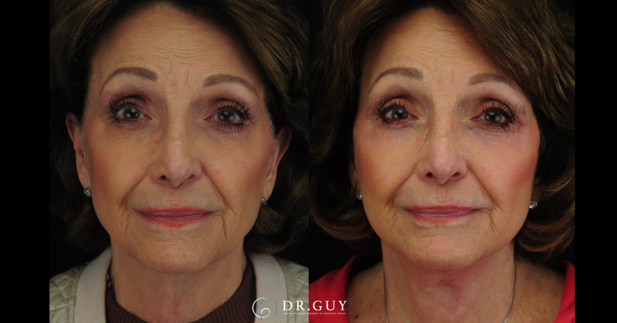 Facelift Before & After Gallery - Patient 707843 - Image 5