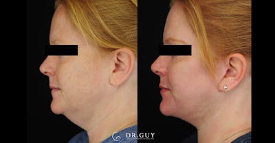 Facelift Before & After Gallery - Patient 266412 - Image 1