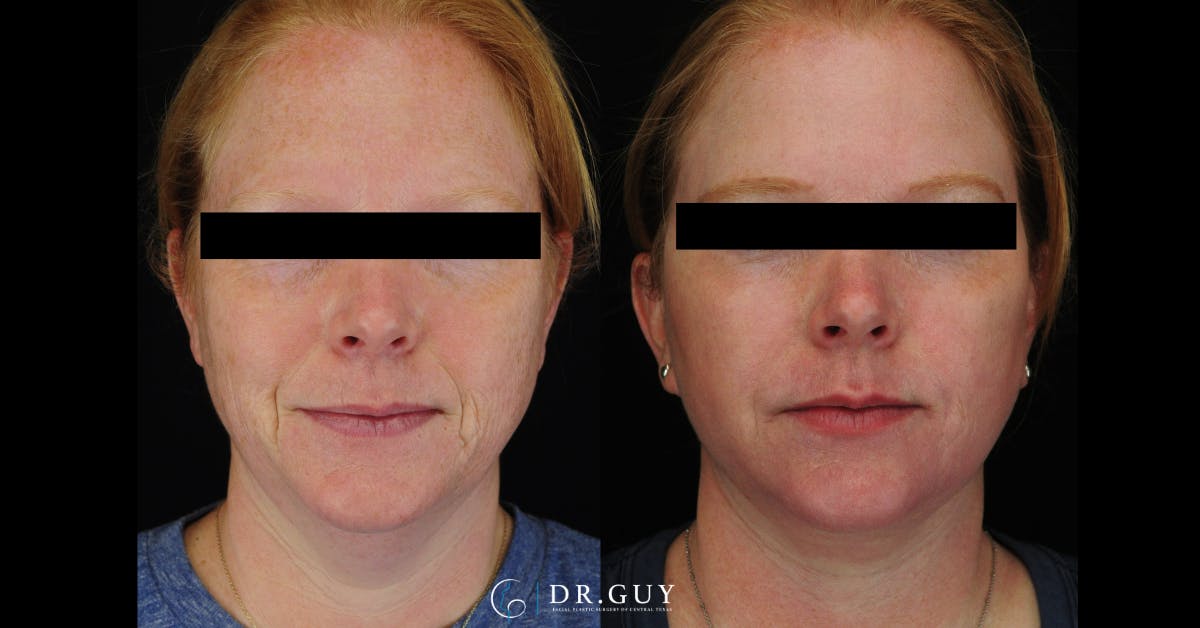 Facelift Before & After Gallery - Patient 266412 - Image 3