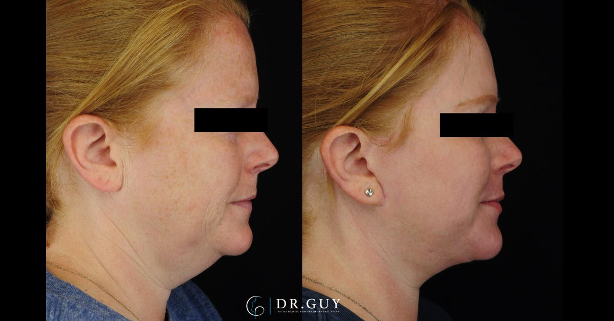Facelift Before & After Gallery - Patient 266412 - Image 4