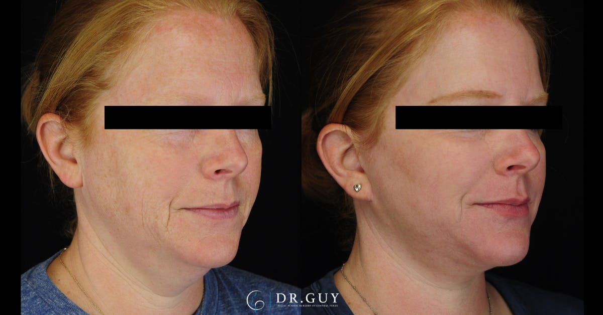 Facelift Before & After Gallery - Patient 266412 - Image 5