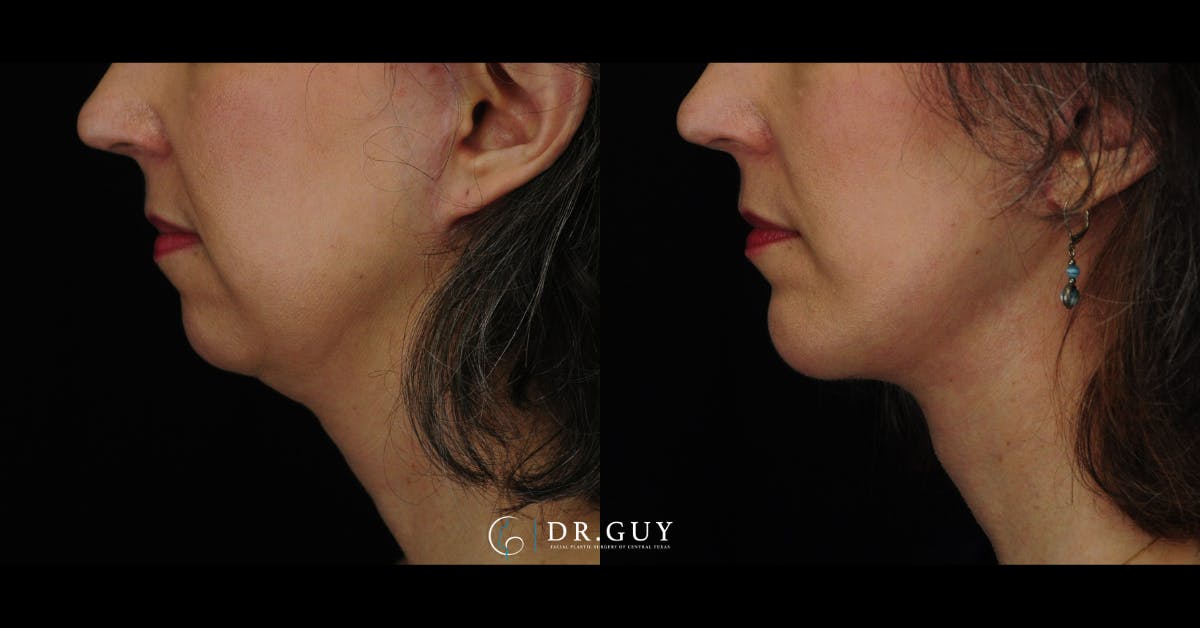 Facelift Before & After Gallery - Patient 360344 - Image 1