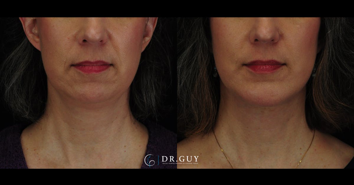 Facelift Before & After Gallery - Patient 360344 - Image 5