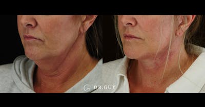 Facelift Before & After Gallery - Patient 204582 - Image 1