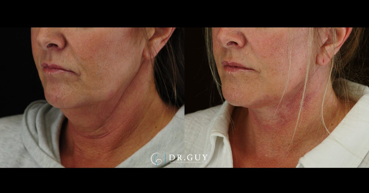 Facelift Before & After Gallery - Patient 204582 - Image 1