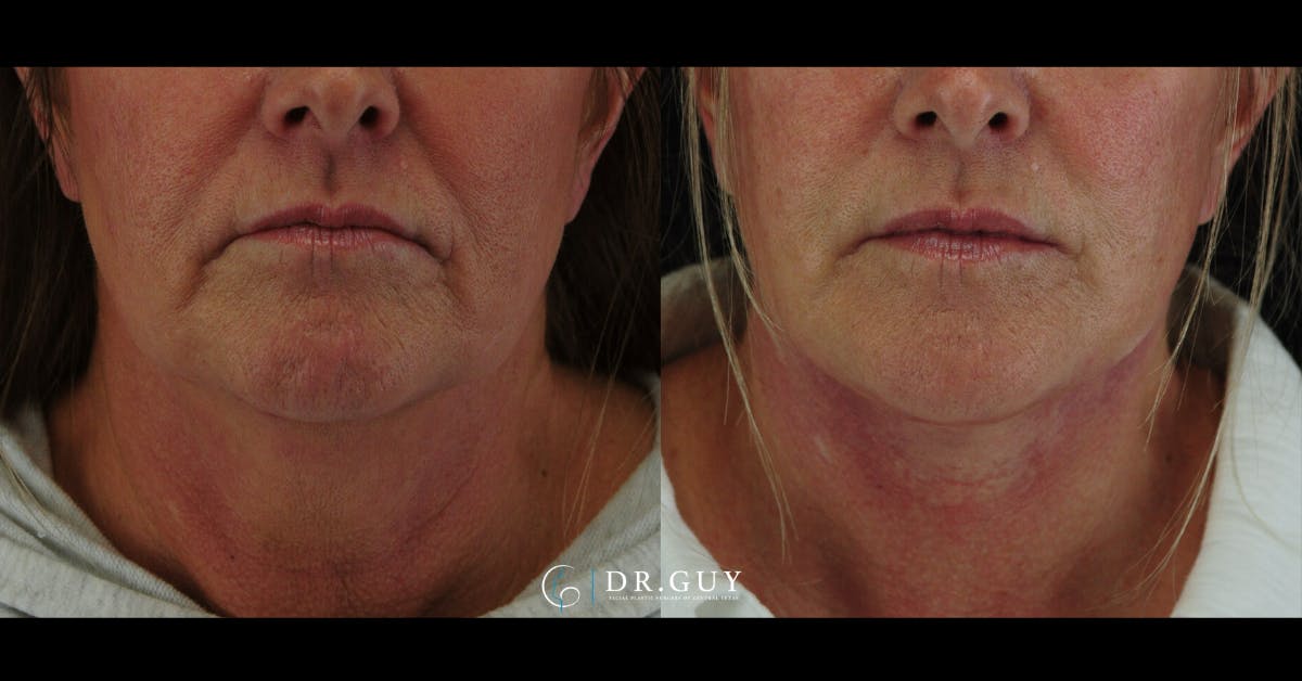 Facelift Before & After Gallery - Patient 204582 - Image 2