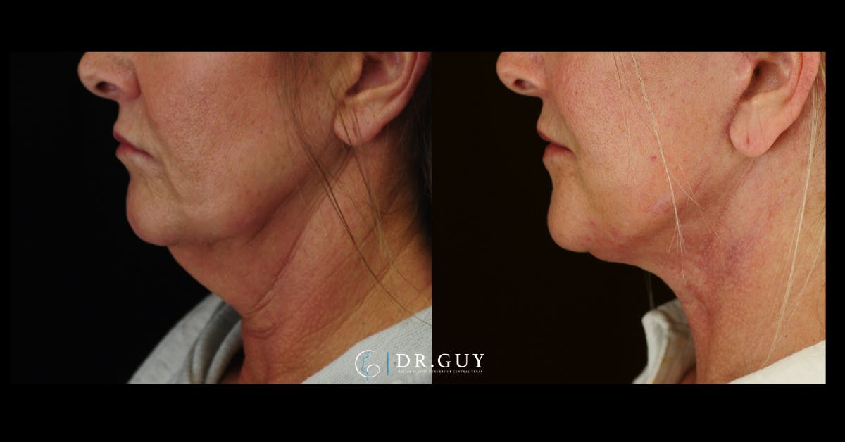 Facelift Before & After Gallery - Patient 204582 - Image 3