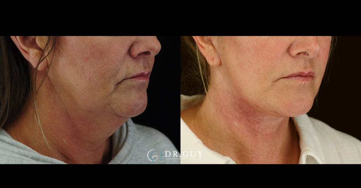 Facelift Before & After Gallery - Patient 204582 - Image 4