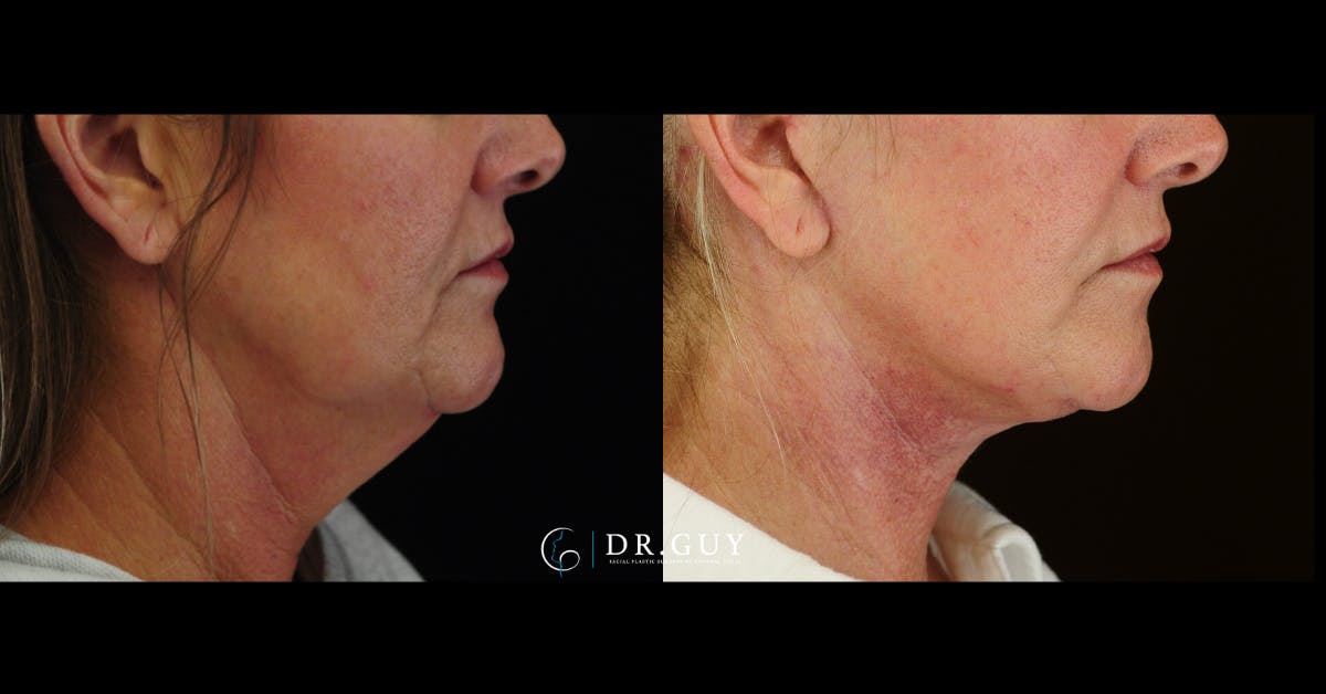 Facelift Before & After Gallery - Patient 204582 - Image 5