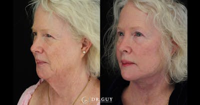 Facelift Before & After Gallery - Patient 309618 - Image 1