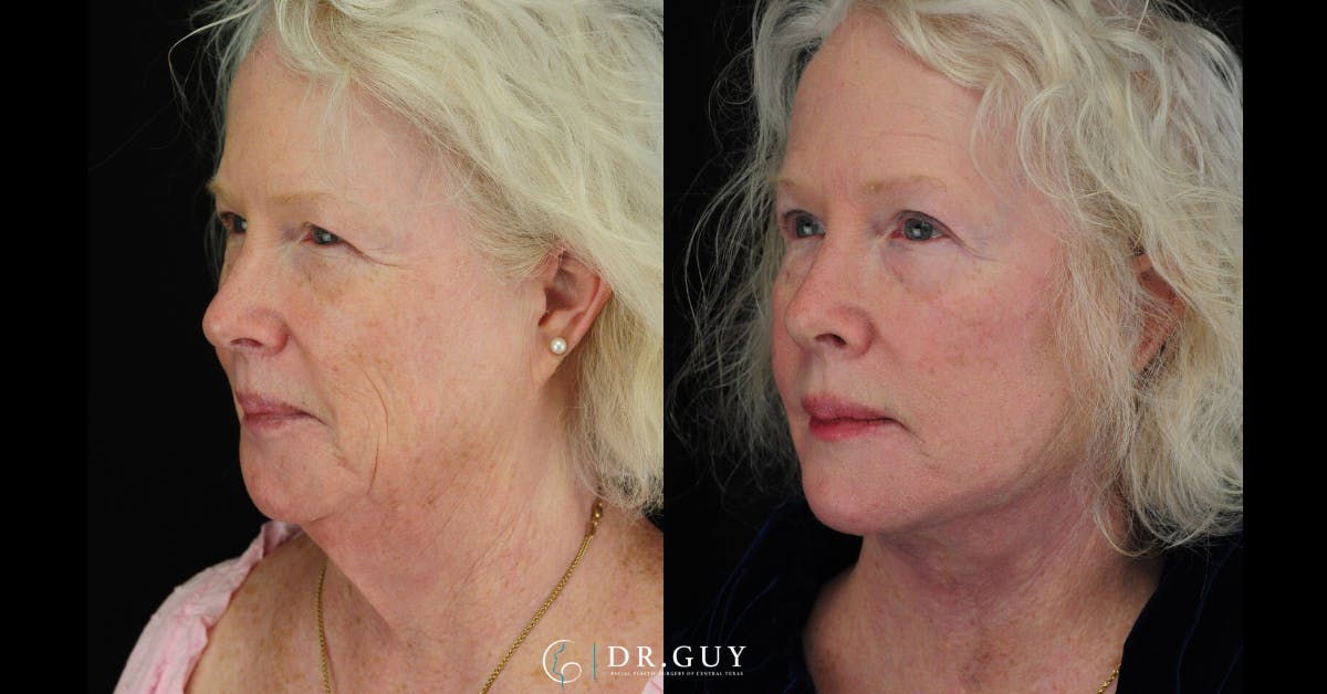 Facelift Before & After Gallery - Patient 309618 - Image 1