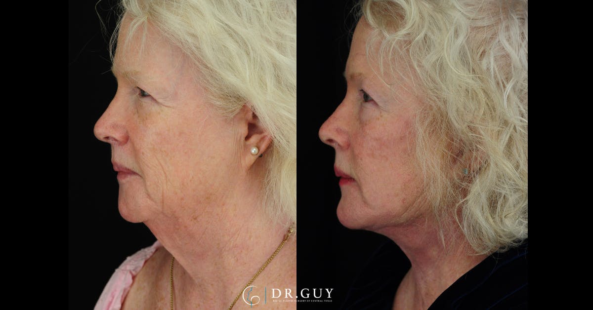 Facelift Before & After Gallery - Patient 309618 - Image 2