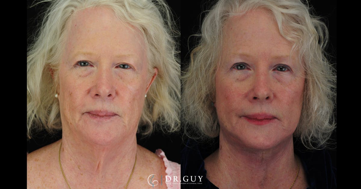 Facelift Before & After Gallery - Patient 309618 - Image 3