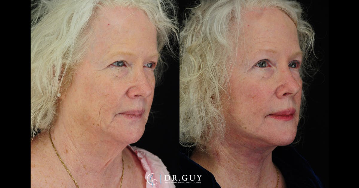 Facelift Before & After Gallery - Patient 309618 - Image 4