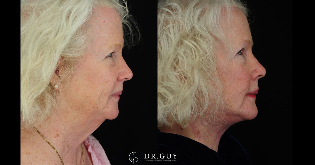 Facelift Before & After Gallery - Patient 309618 - Image 5