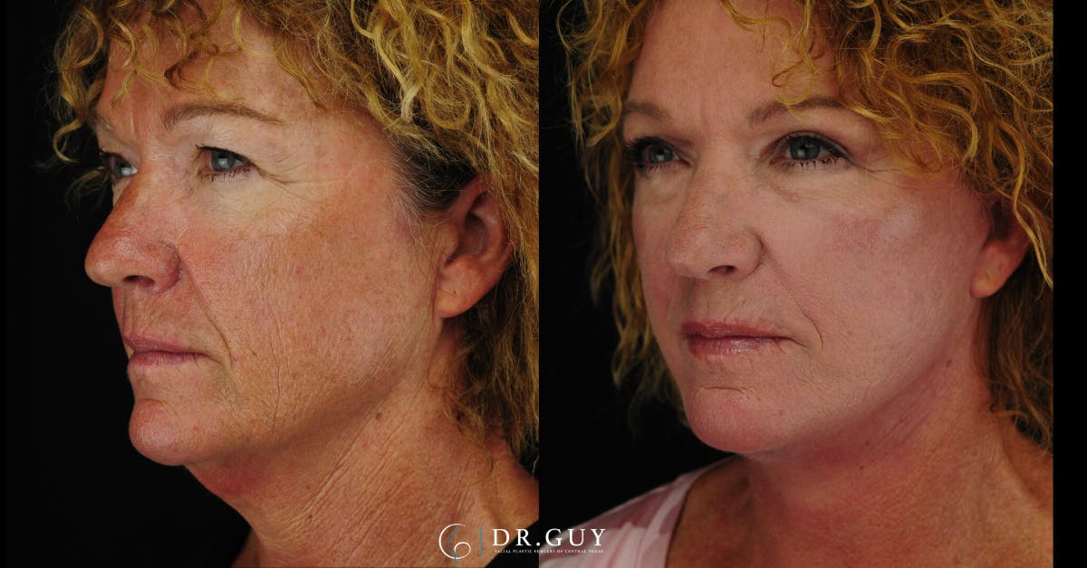 Facelift Before & After Gallery - Patient 177140 - Image 2