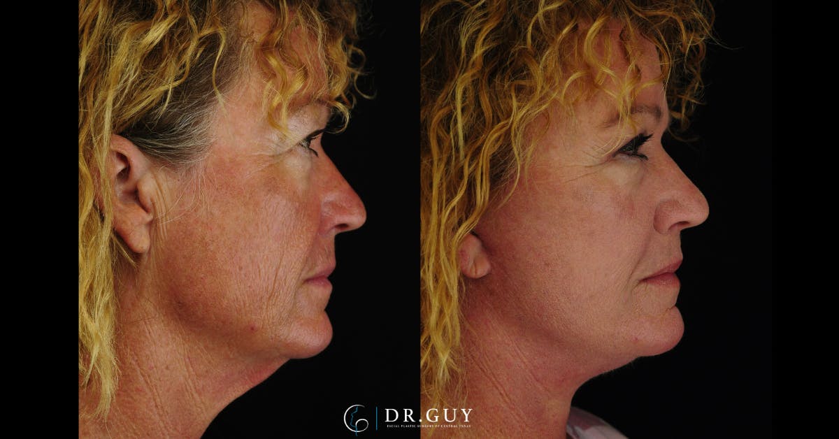 Facelift Before & After Gallery - Patient 177140 - Image 3