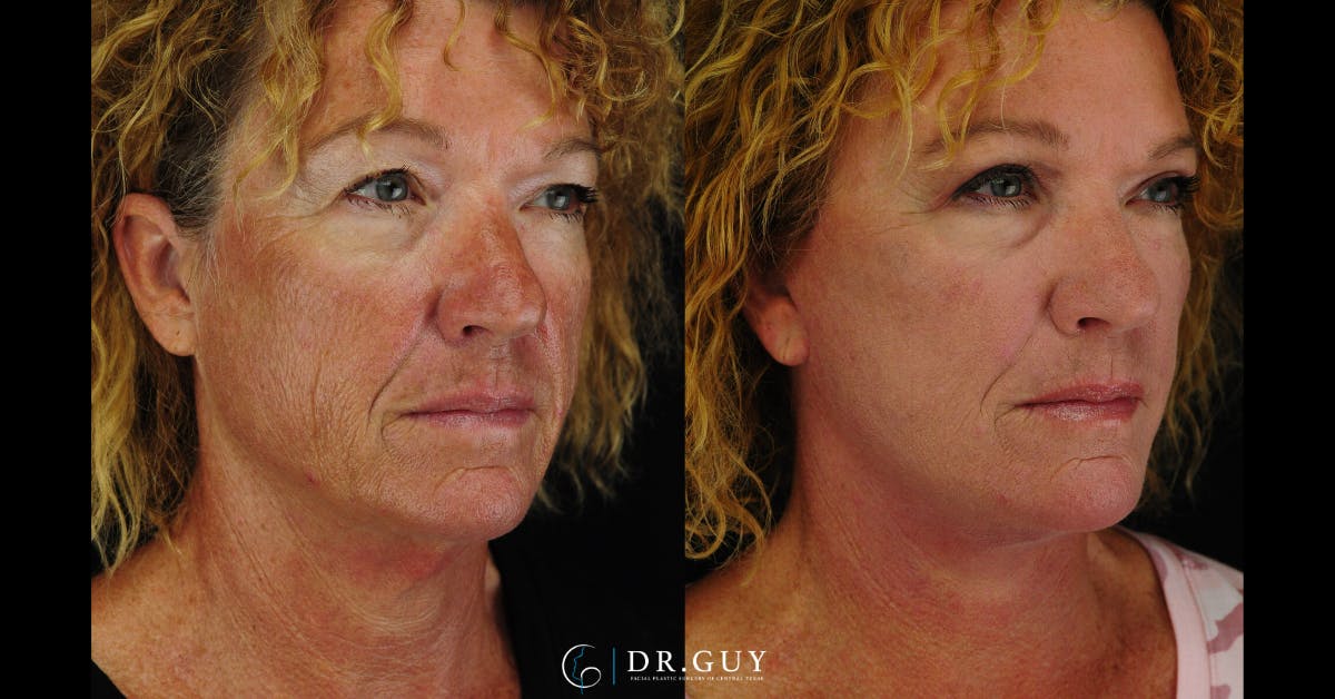 Facelift Before & After Gallery - Patient 177140 - Image 4