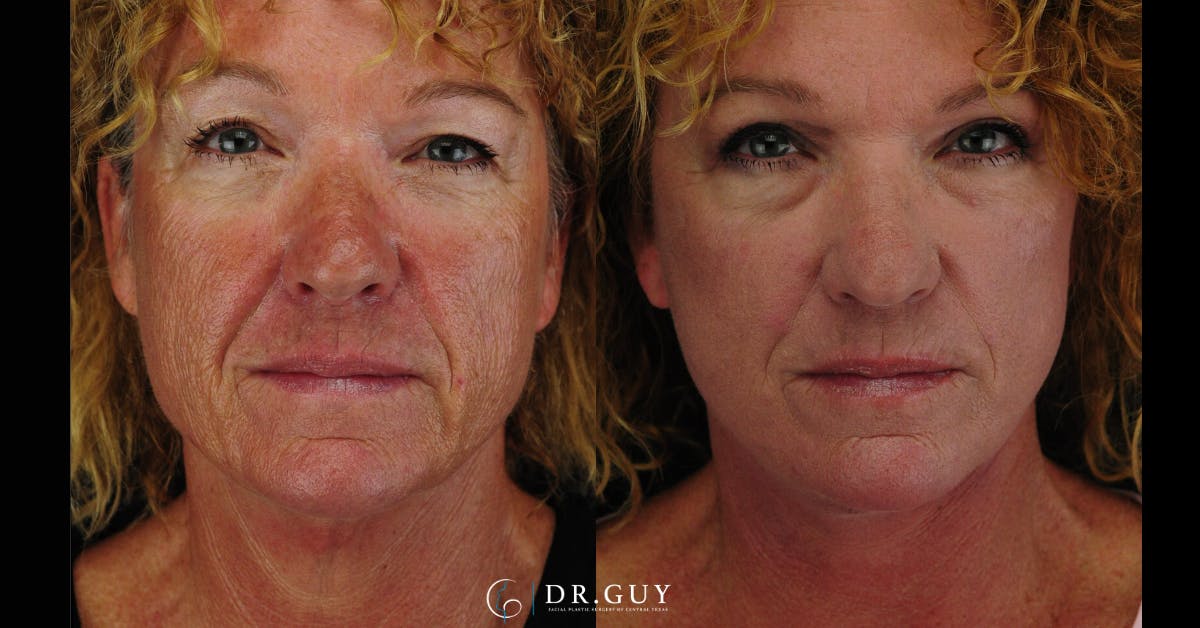Facelift Before & After Gallery - Patient 177140 - Image 5