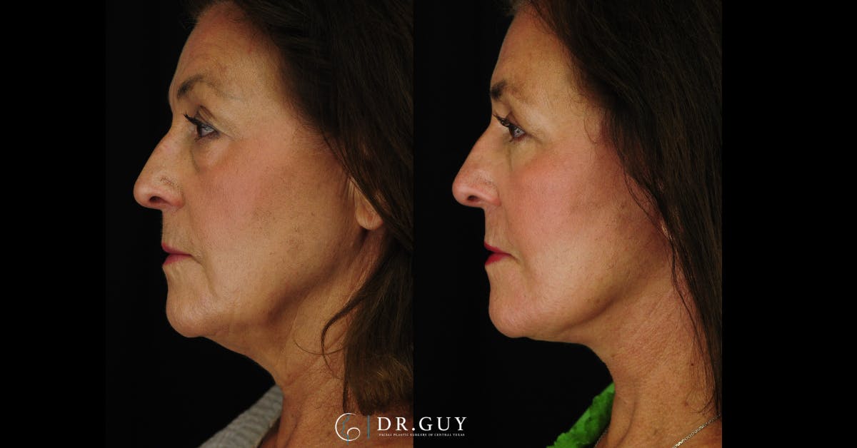 Facelift Before & After Gallery - Patient 340907 - Image 3