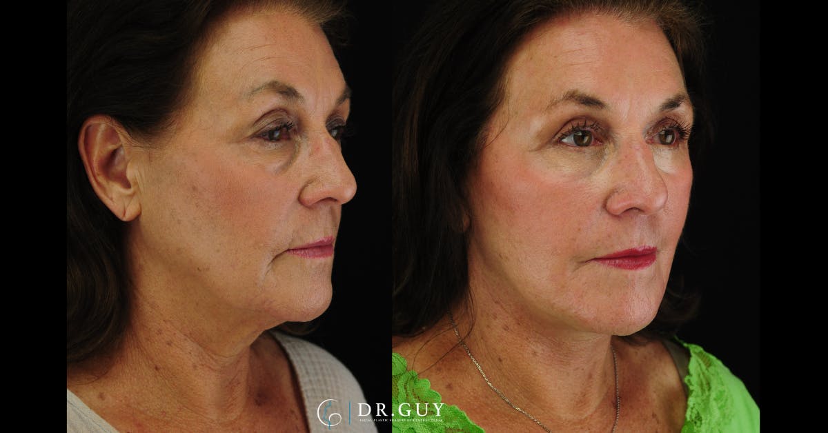 Facelift Before & After Gallery - Patient 340907 - Image 4