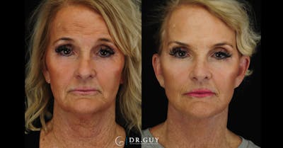 Facelift Before & After Gallery - Patient 121824 - Image 1