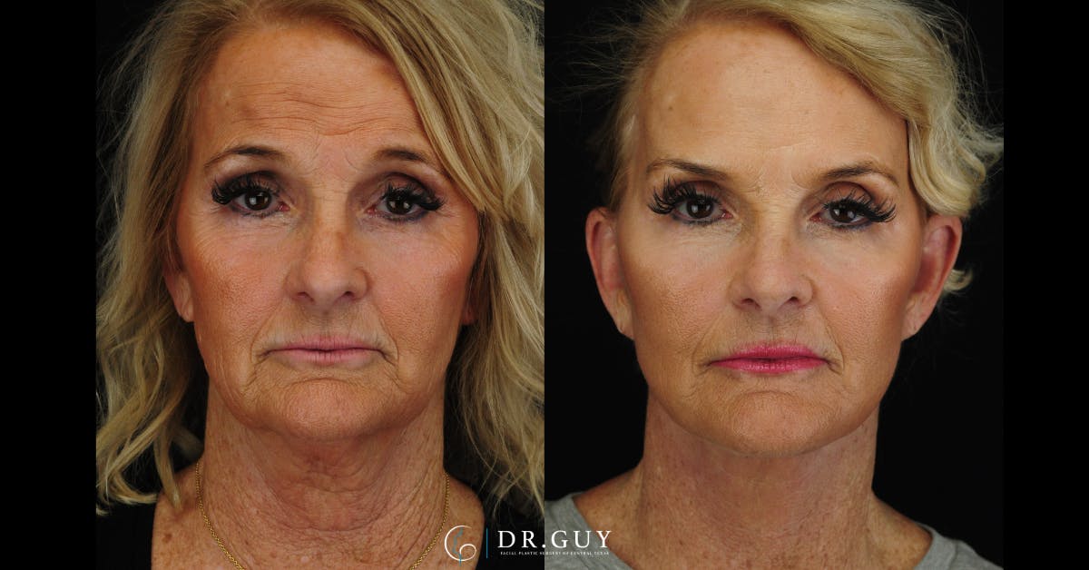 Facelift Before & After Gallery - Patient 121824 - Image 1