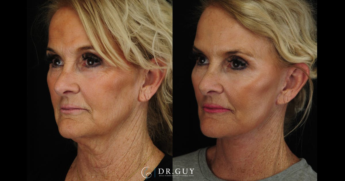 Facelift Before & After Gallery - Patient 121824 - Image 2