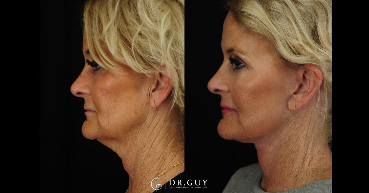 Facelift Before & After Gallery - Patient 121824 - Image 3