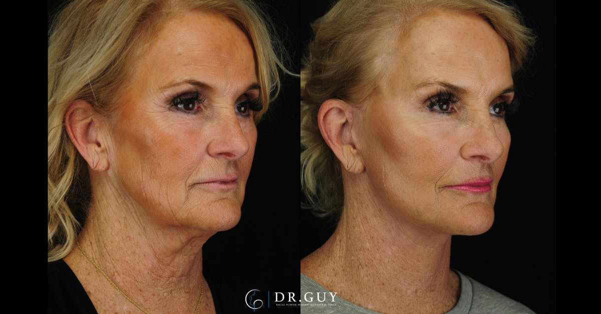 Facelift Before & After Gallery - Patient 121824 - Image 4