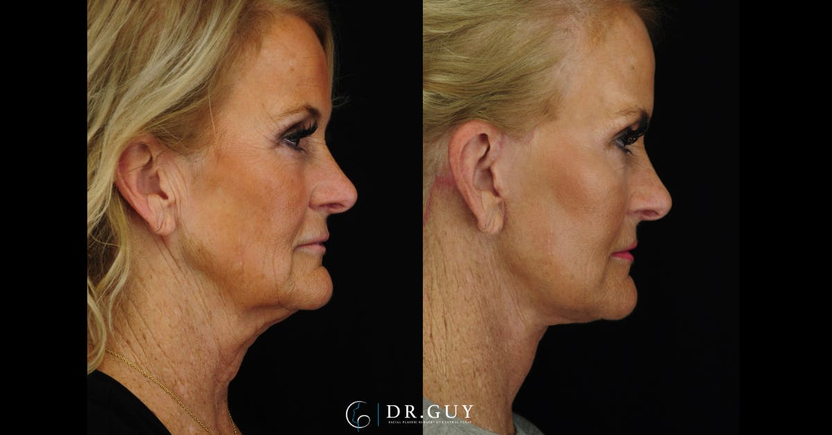 Facelift Before & After Gallery - Patient 121824 - Image 5
