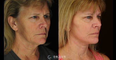 Facelift Before & After Gallery - Patient 310670 - Image 1